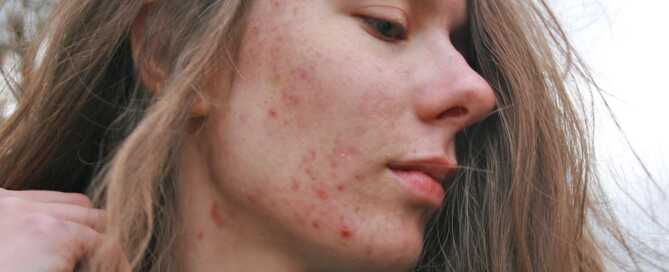 Toxins in the body